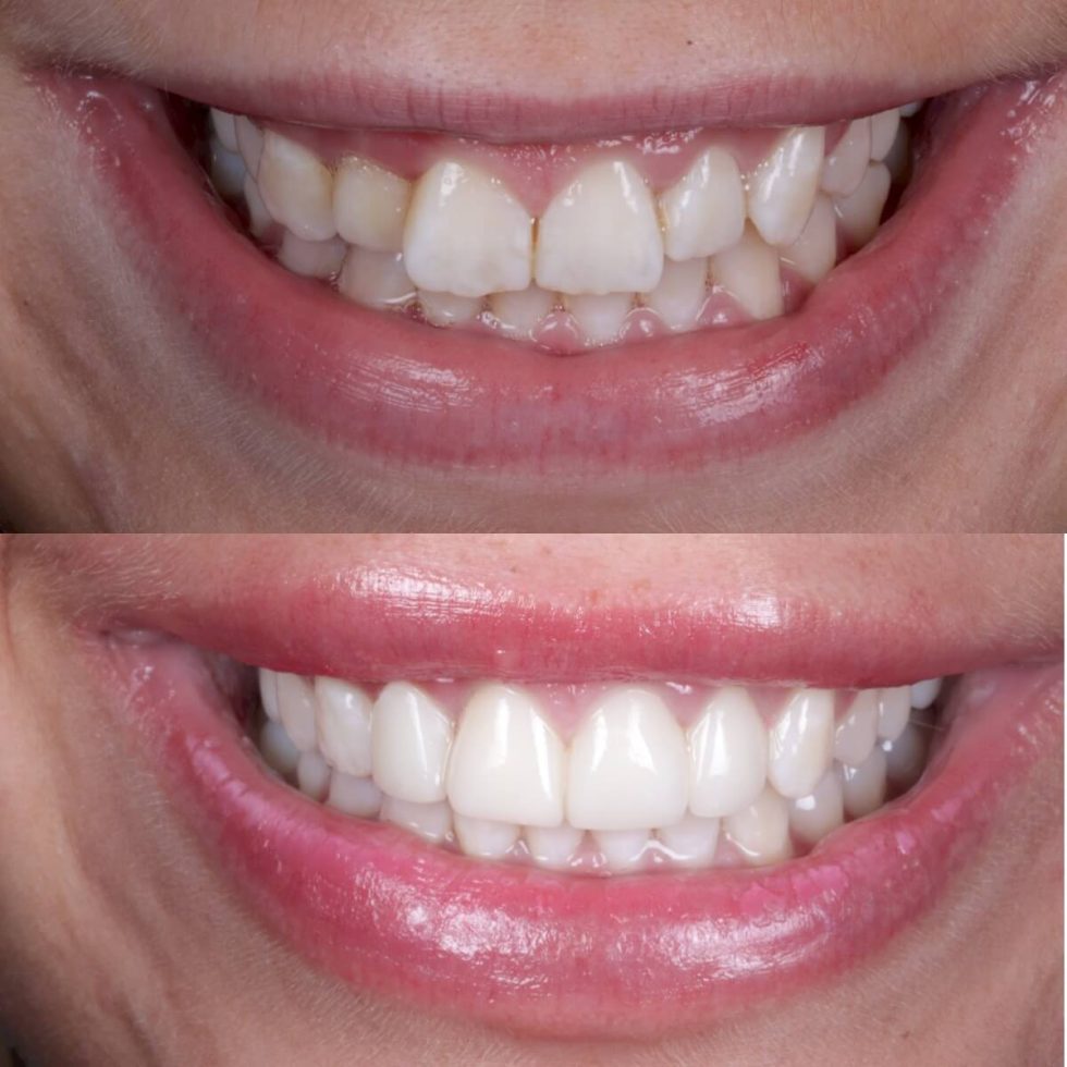 Invisalign Braces | Invisible Teeth Straightening Solihull